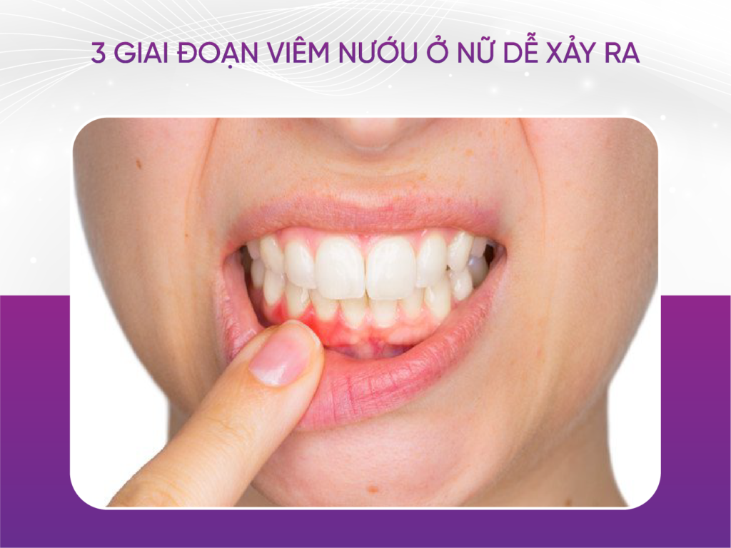 3 giai đoạn tình trạng viêm nướu ở nữ dễ xảy ra Lưu Ý Khi Sử Dụng Thuốc Giảm Đau Răng Khôn Tại Nhà