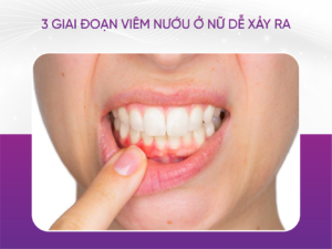 Lưu Ý Khi Sử Dụng Thuốc Giảm Đau Răng Khôn Tại Nhà