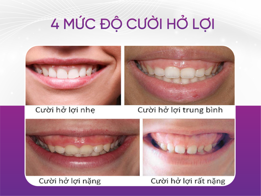 Cười hở lợi và 4 mức độ cười hở lợi mà khách hàng cần biết 4 Mức Độ Cười Hở Lợi