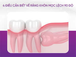 4 Điều Về Răng Khôn Mọc Lệch 90 Độ Mà Mọi Người Cần Lưu Ý