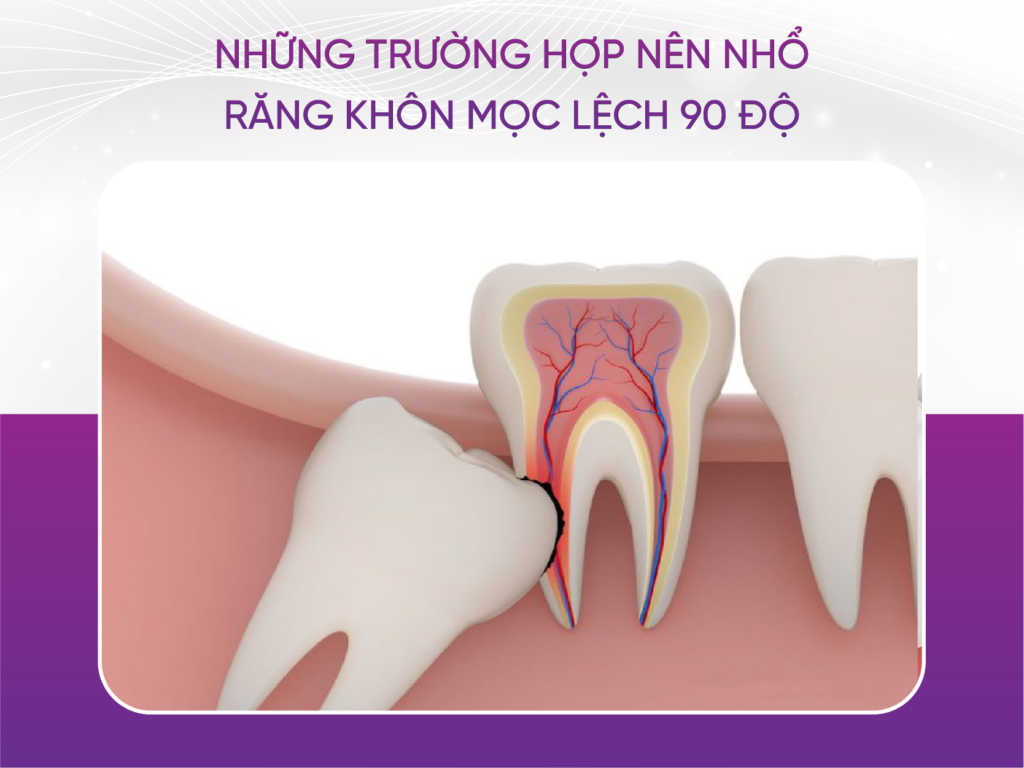 Những điều cần lưu ý về răng khôn mọc lệch 90 độ Những Trường Hợp Nên Loại Bỏ Răng Khôn Mọc Lệch 90 Độ