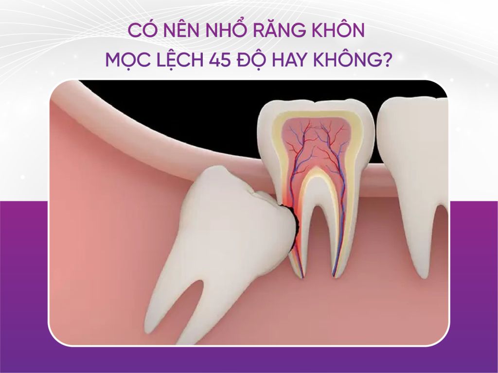 Có Nên Nhổ Răng Khôn Mọc Lệch 45 Độ Hay Không?