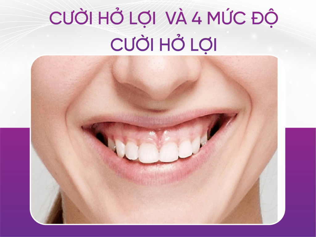 Cười hở lợi và 4 mức độ cười hở lợi mà khách hàng cần biết Cười Hở Lợi Và 4 Mức Độ Cười Hở Lợi