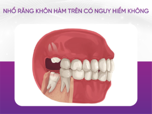 Nhổ Răng Khôn Hàm Trên Có Nguy Hiểm Không?