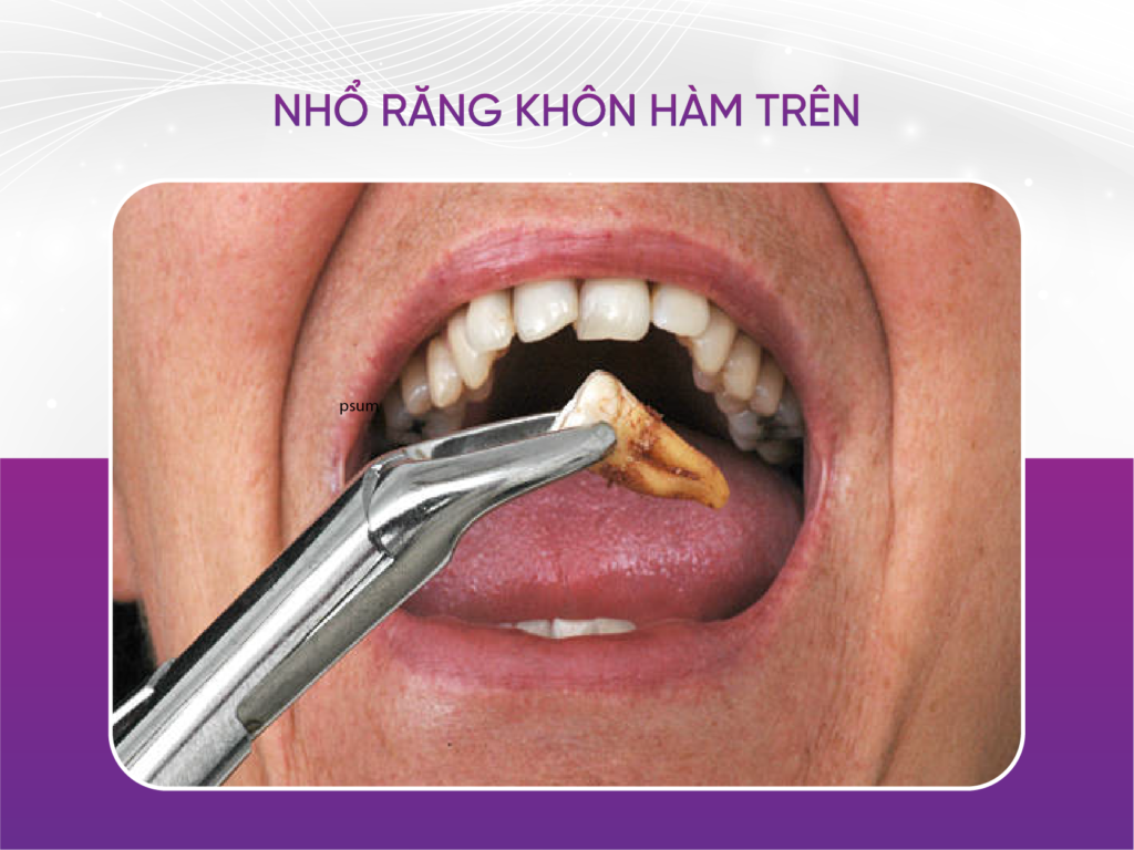 Nhổ răng khôn hàm trên có nguy hiểm không? 4 thời điểm tuyệt đối không nhổ Nhổ Răng Khôn Hàm Trên