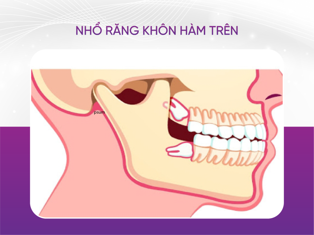 Nhổ răng khôn hàm trên có nguy hiểm không? 4 thời điểm tuyệt đối không nhổ Nhổ Răng Khôn Hàm Trên