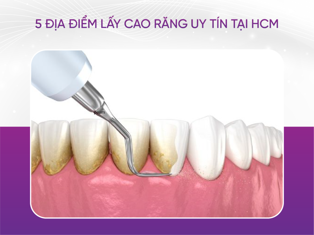 5 địa điểm lấy cao răng uy tín tại Hồ Chí Minh 5 Địa Điểm Lấy Cao Răng Uy Tín Tại Hồ Chí Minh