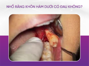 Nhổ Răng Khôn Hàm Dưới Có Đau Không?
