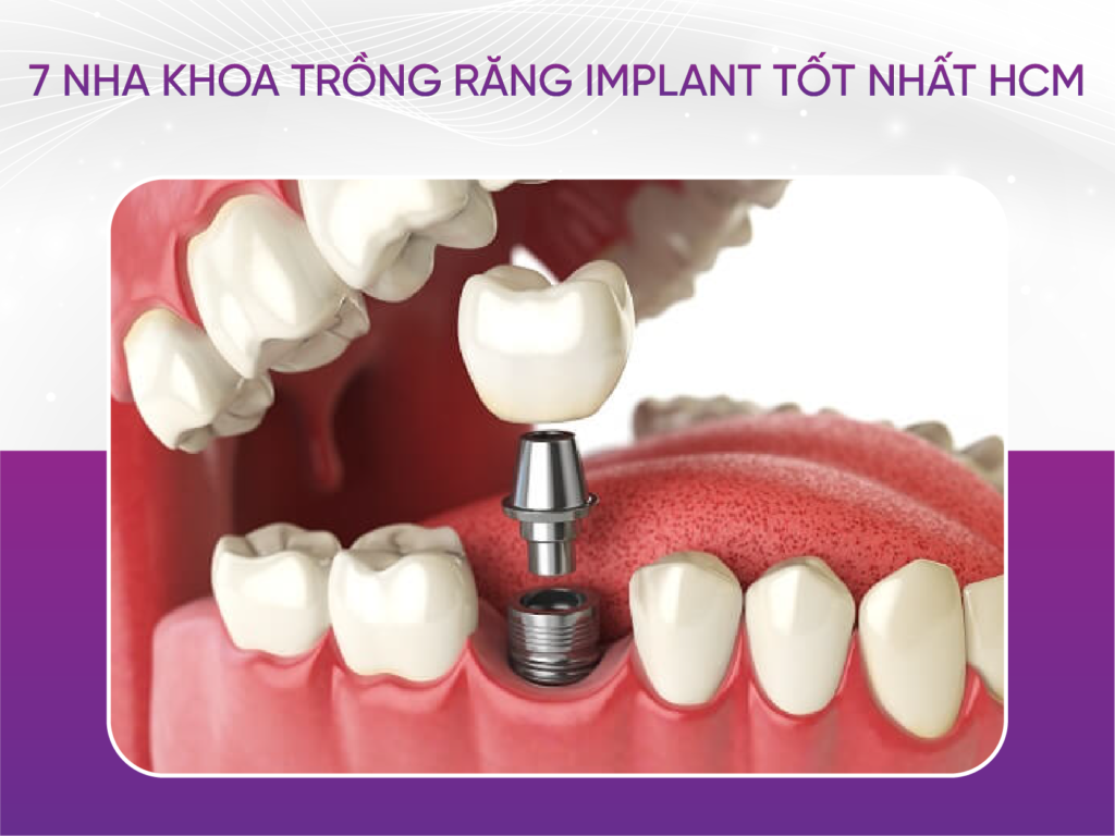 Trồng Răng Implant Có Đau Không và 7 Nha Khoa Uy Tín Trồng Răng Implant Có Đau Không? 7 Nha Khoa Trồng Răng Implant Tốt Nhất Hồ Chí Minh