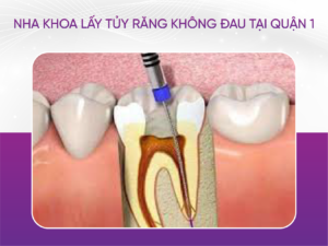 Lấy Tủy Răng Có Đau Không?
