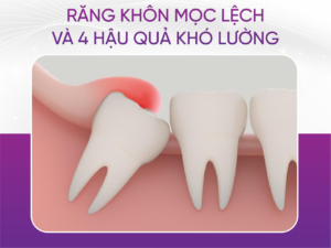 Răng Khôn Mọc Lệch