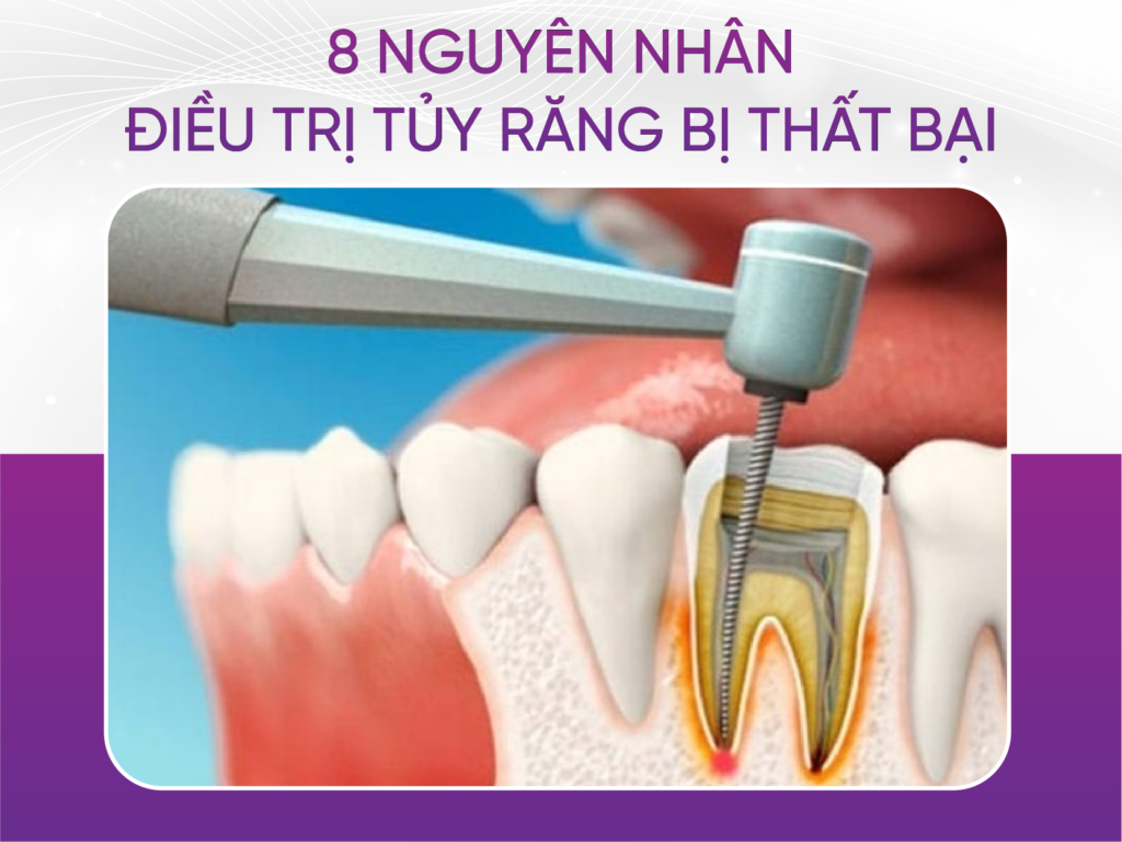 8 nguyên nhân dẫn đến điều trị tủy răng thất bại 8 Nguyên Nhân Dẫn Đến Điều Trị Tủy Răng Thất Bại