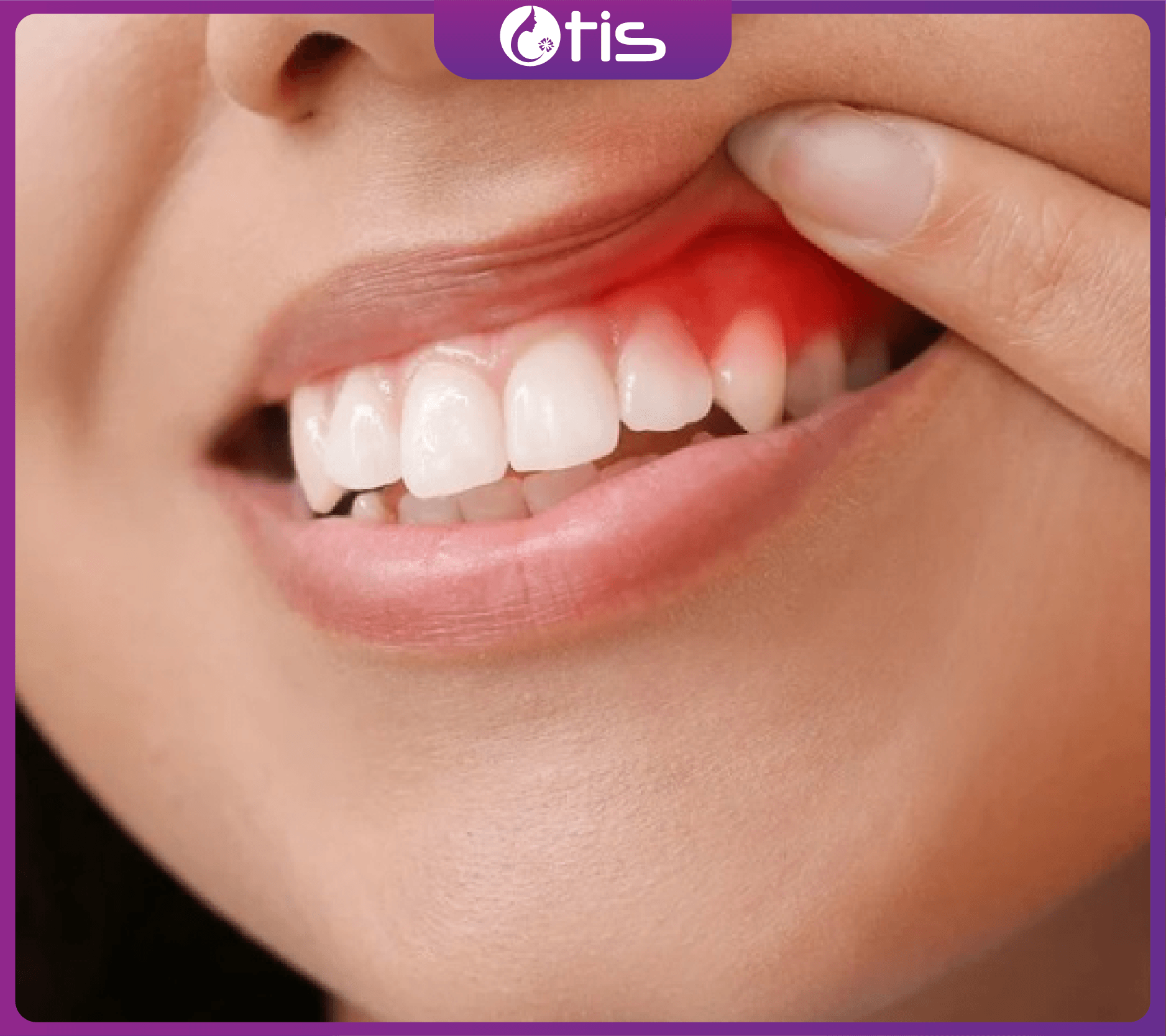 4 nguyên nhân gây viêm nướu răng và cách điều trị Viêm Nướu Răng