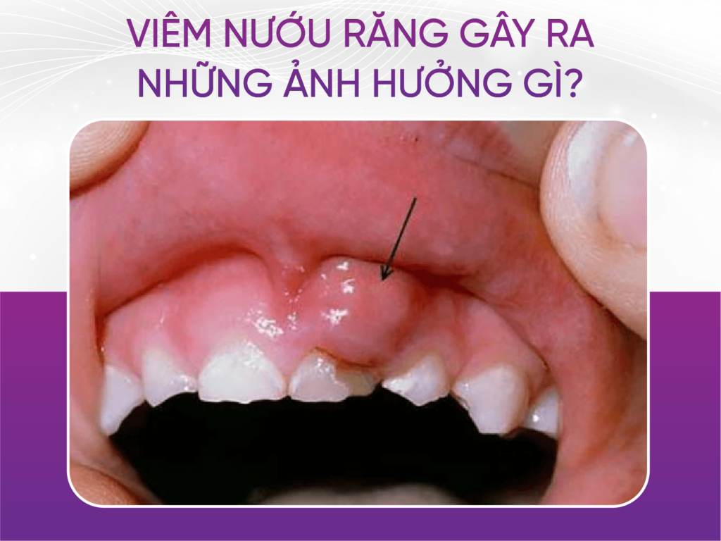 4 nguyên nhân gây viêm nướu răng và cách điều trị Ảnh Hưởng Của Viêm Nướu Răng