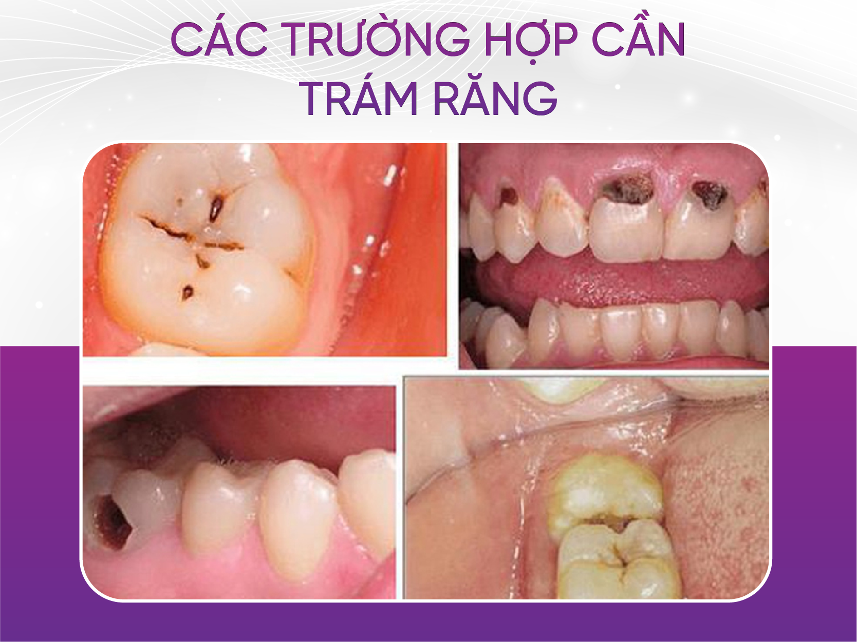 Khi nào cần trám răng và quy trình trám răng mới nhất 2024 Các Trường Hợp Cần Trám Răng