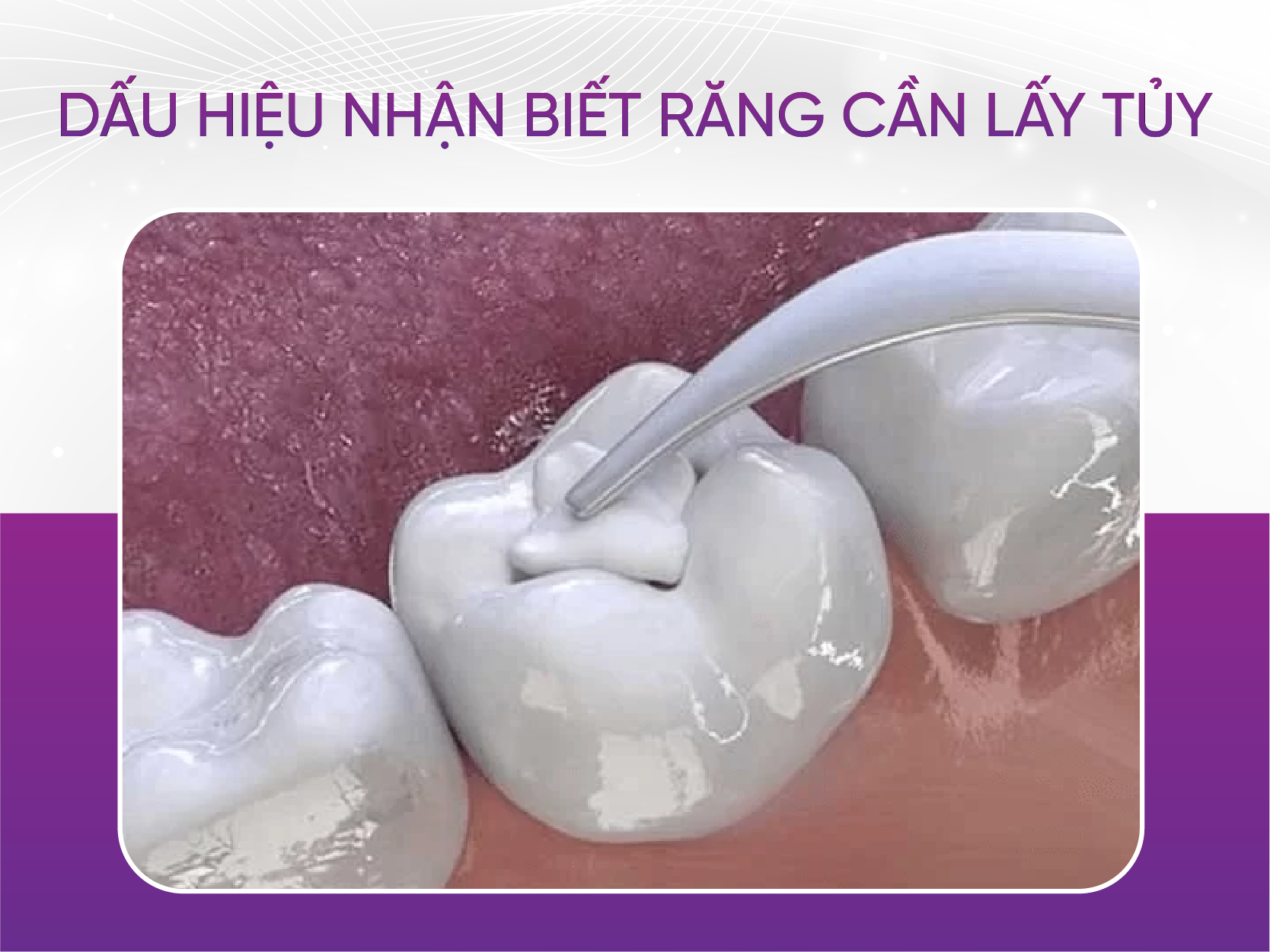 Khi nào cần trám răng lấy tủy? Dấu Hiệu Nhận Biết Răng Cần Lấy Tủy