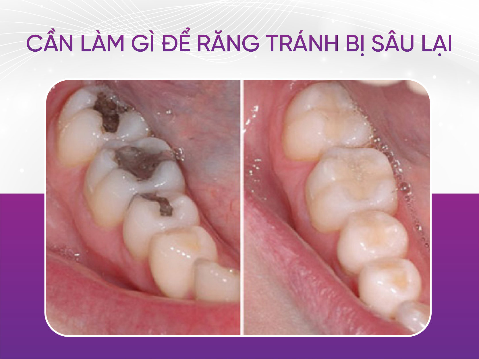 làm gì để tránh răng bị sâu trở lại