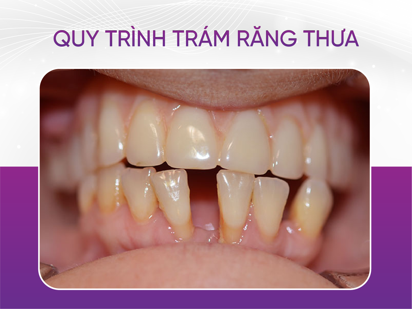 Chi phí trám răng thưa bao nhiêu tiền - Bảng giá 2024 Quy Trình Trám Răng Thưa