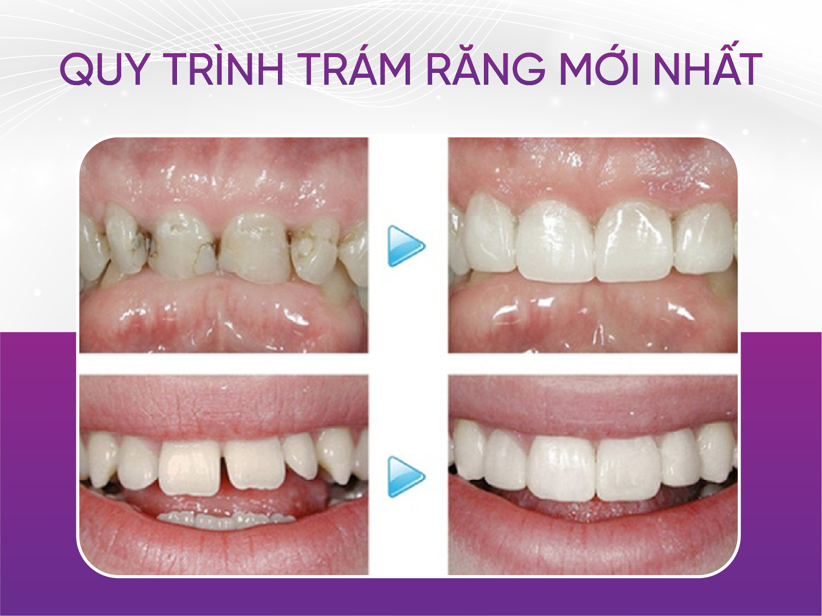 Khi nào cần trám răng và quy trình trám răng mới nhất 2024 Quy Trình Trám Răng