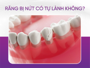 Răng Bị Nứt Có Lành Lại Được Không