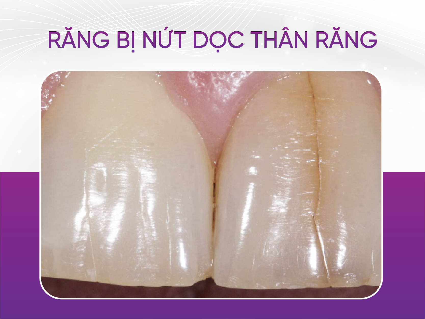 răng bị nứt dọc thân răng