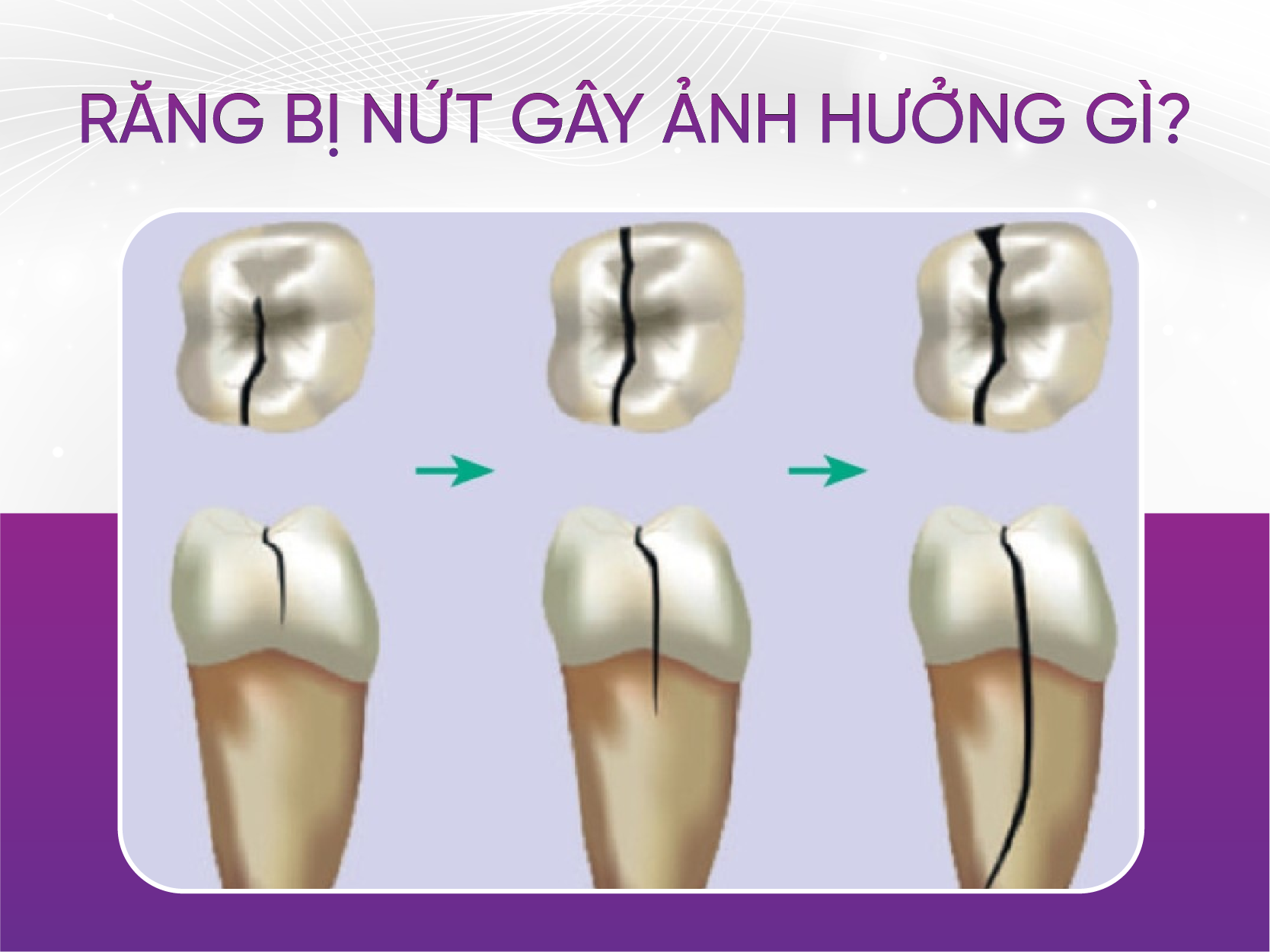 răng bị nứt gây ảnh hưởng gi