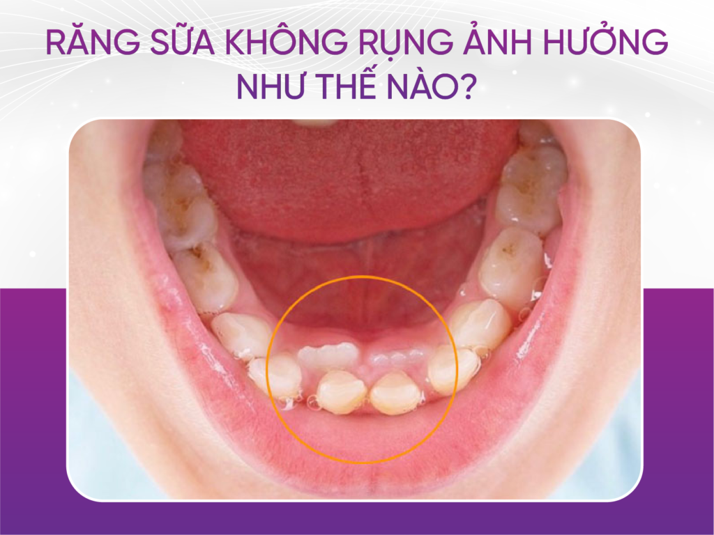 Vì sao có trẻ không rụng răng sữa? Răng Sữa Không Rụng Ảnh Hưởng Như Thế Nào