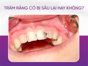 Trám Răng Bị Sâu Lại Không