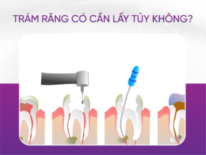 Trám Răng Có Cần Lấy Tủy Không