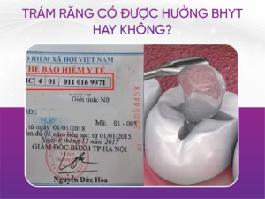 Trám Răng Có Được Hưởng Bảo Hiểm Y Tế Hay Không