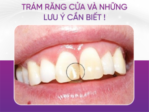 Trám Răng Cửa