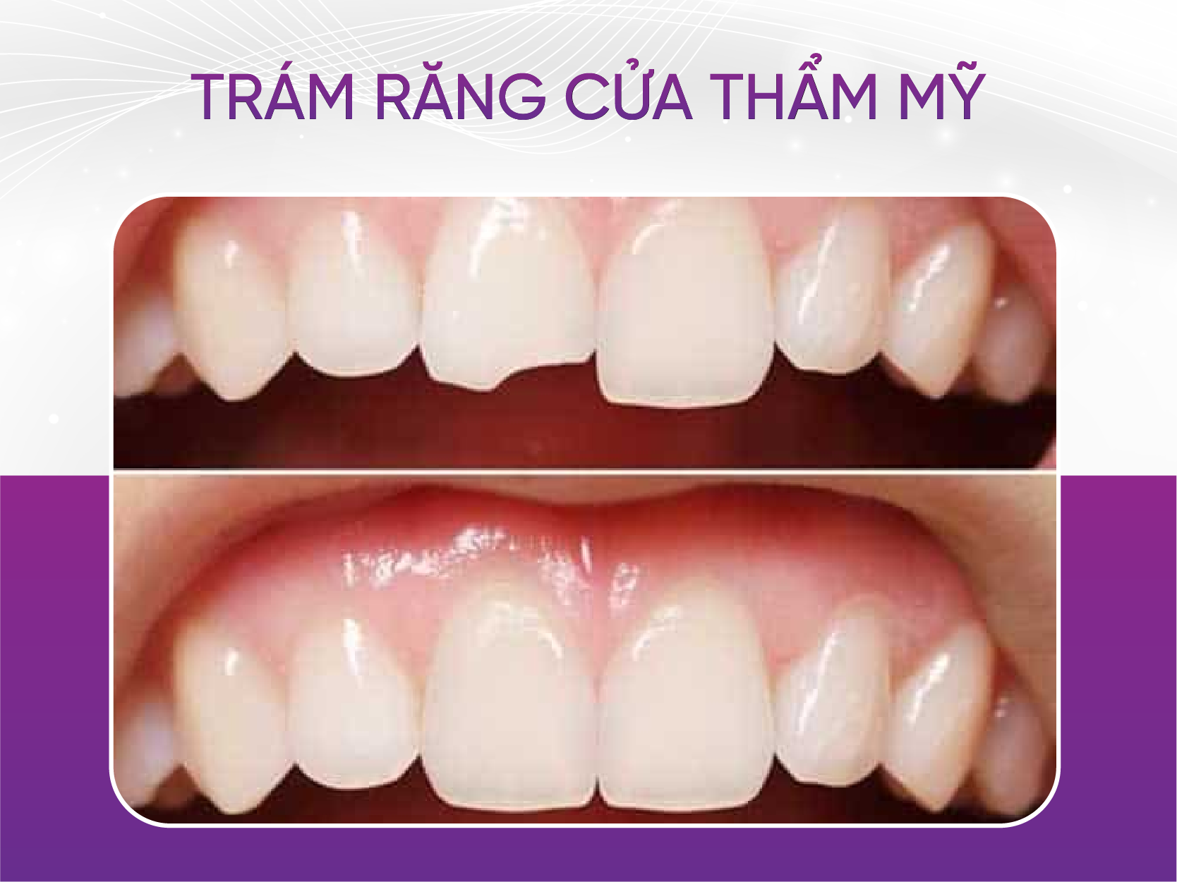 Trám răng cửa và 6 lưu ý bạn cần biết Trám Răng Cửa Thẩm Mỹ