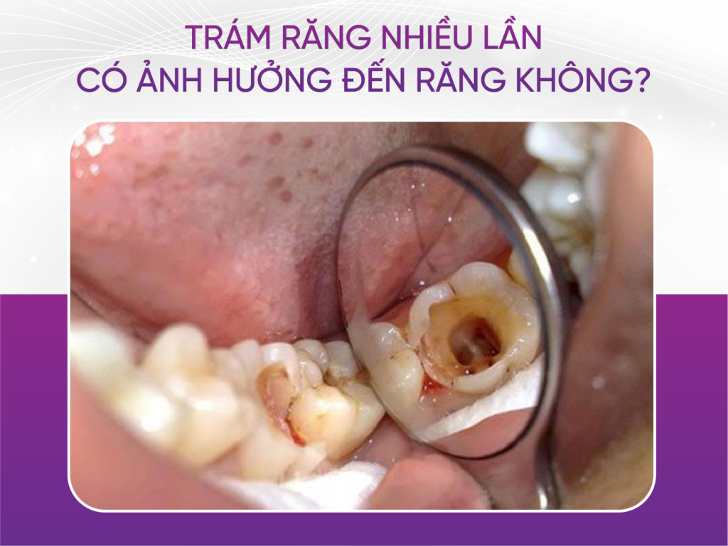 Trám răng nhiều lần có làm răng yếu đi không? Trám Răng Nhiều Lần
