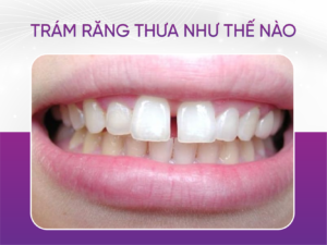 Trám Răng Thưa