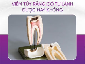 Viêm Tủy Răng Có Tự Lành Được Hay Không