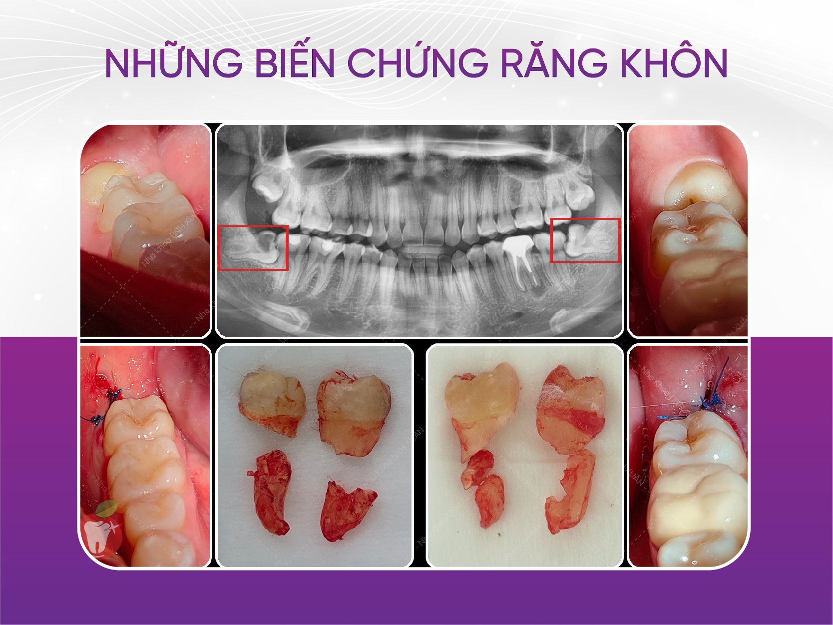 Răng khôn mọc lệch 90 độ và những điều cần lưu ý khi nhổ Biến Chứng Răng Khôn Mọc Lệch