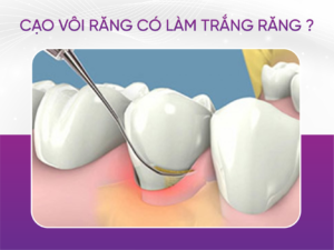 Cạo Vôi Răng Có Làm Trắng Răng