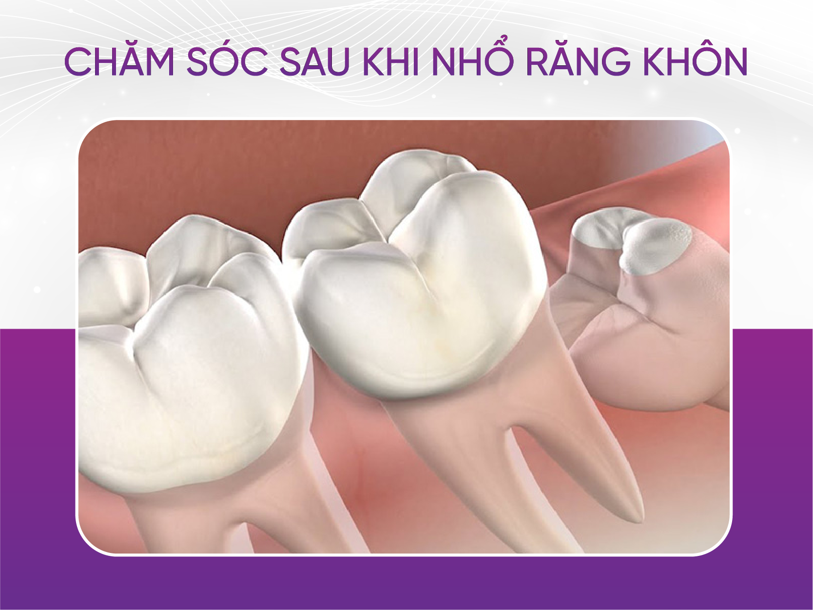 chăm sóc sau khi nhổ răng khôn