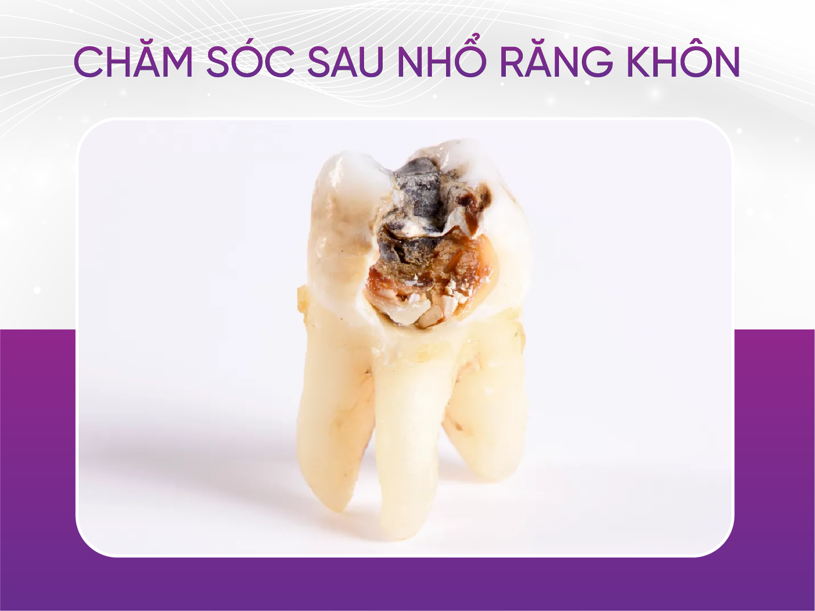 chăm sóc sau nhổ răng khôn