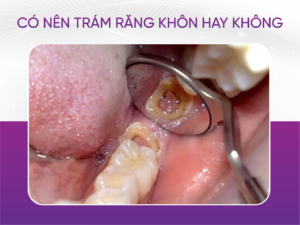 Có Nên Trám Răng Khôn Hay Không