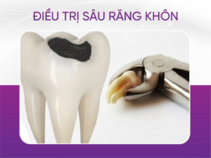 Điều Trị Sâu Răng Khôn