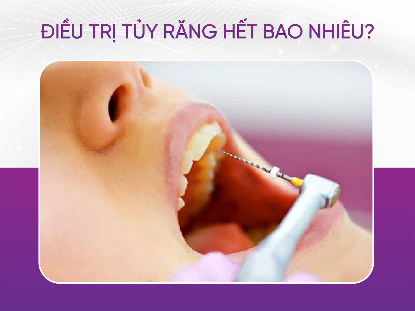 điều trị tủy hết bao nhiêu tiền