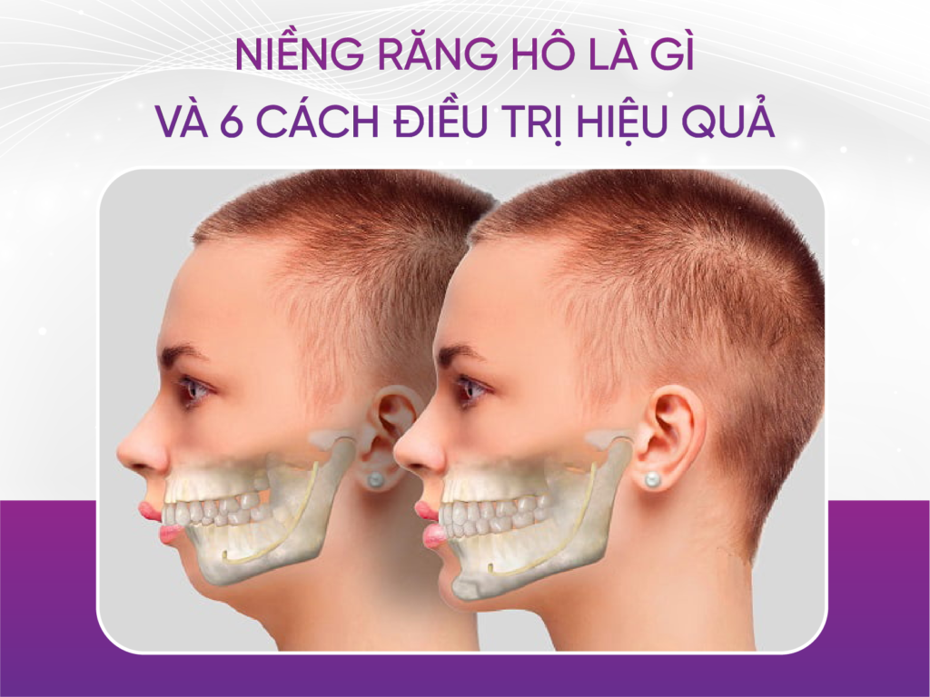 Niềng răng hô là gì và 6 phương pháp điều trị hiệu quả Niềng Răng Hô