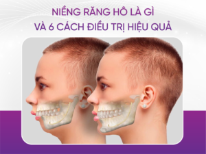 Niềng Răng Hô