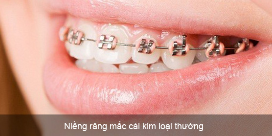 Niềng răng mắc cài kim loại và 5 ưu điểm nổi bật 5 Ưu Điểm Của Niềng Răng Mắc Cài Kim Loại