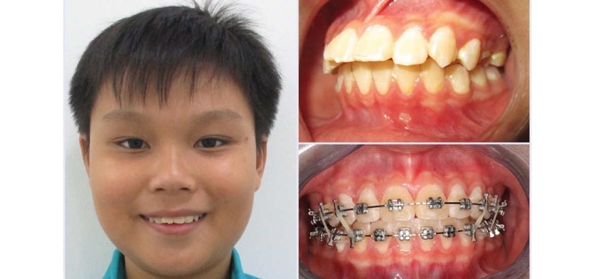 Niềng răng mắc cài kim loại và 5 ưu điểm nổi bật 5 Ưu Điểm Của Niềng Răng Mắc Cài Kim Loại