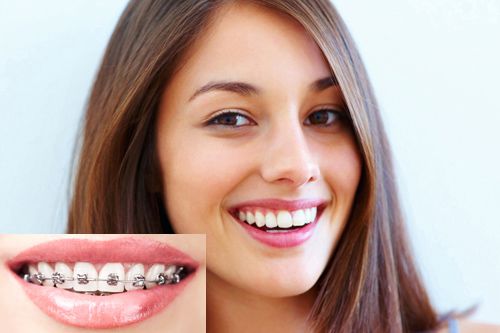 Niềng răng mắc cài kim loại và 5 ưu điểm nổi bật