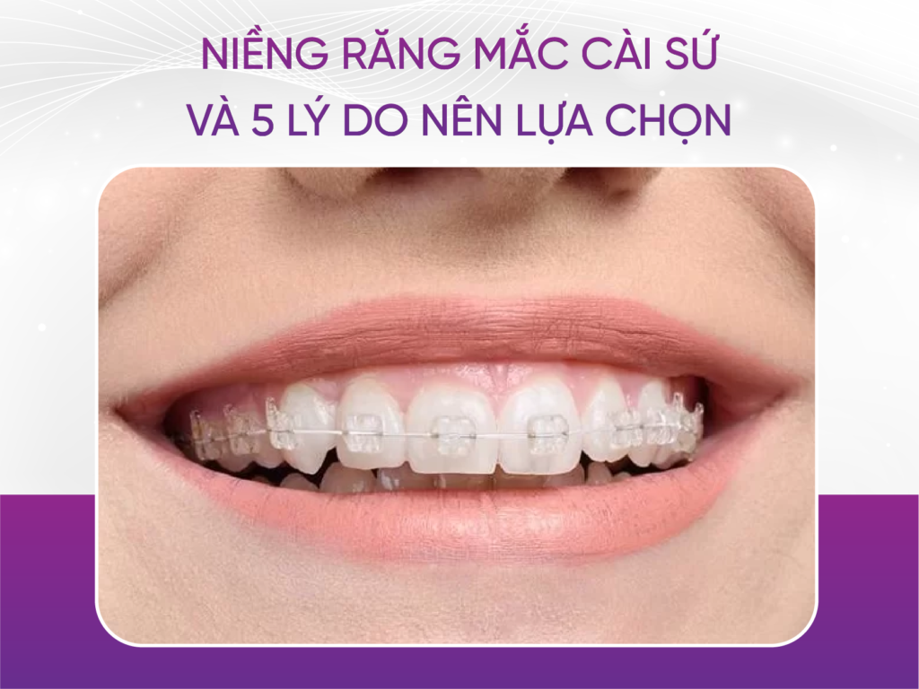 Niềng Răng Mắc Cài Sứ