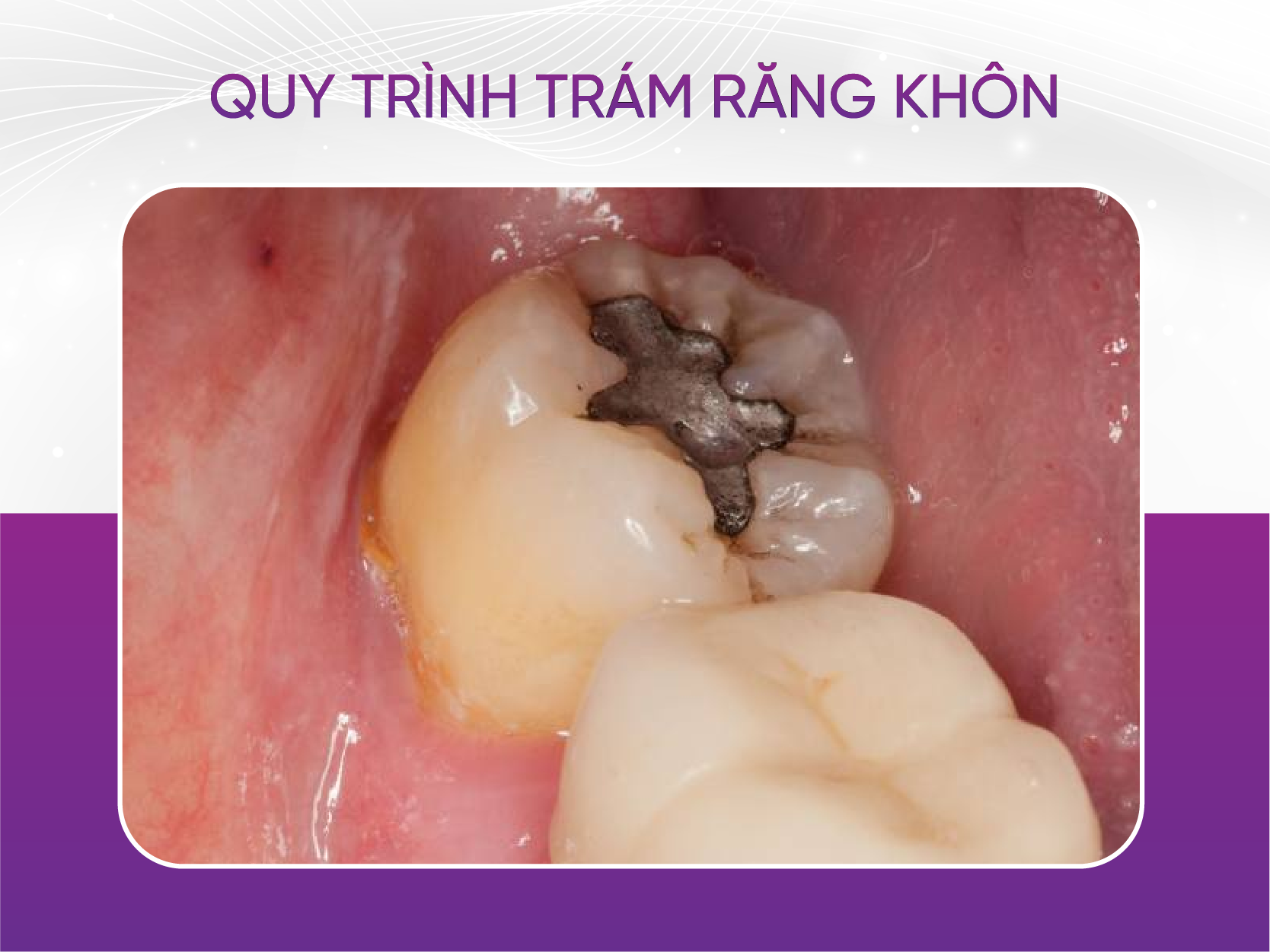 Có nên trám răng khôn hay không và 4 lưu ý bạn cần biết Quy Trình Trám Răng Khôn