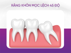 Răng Khôn Mọc Lệch 45 Độ